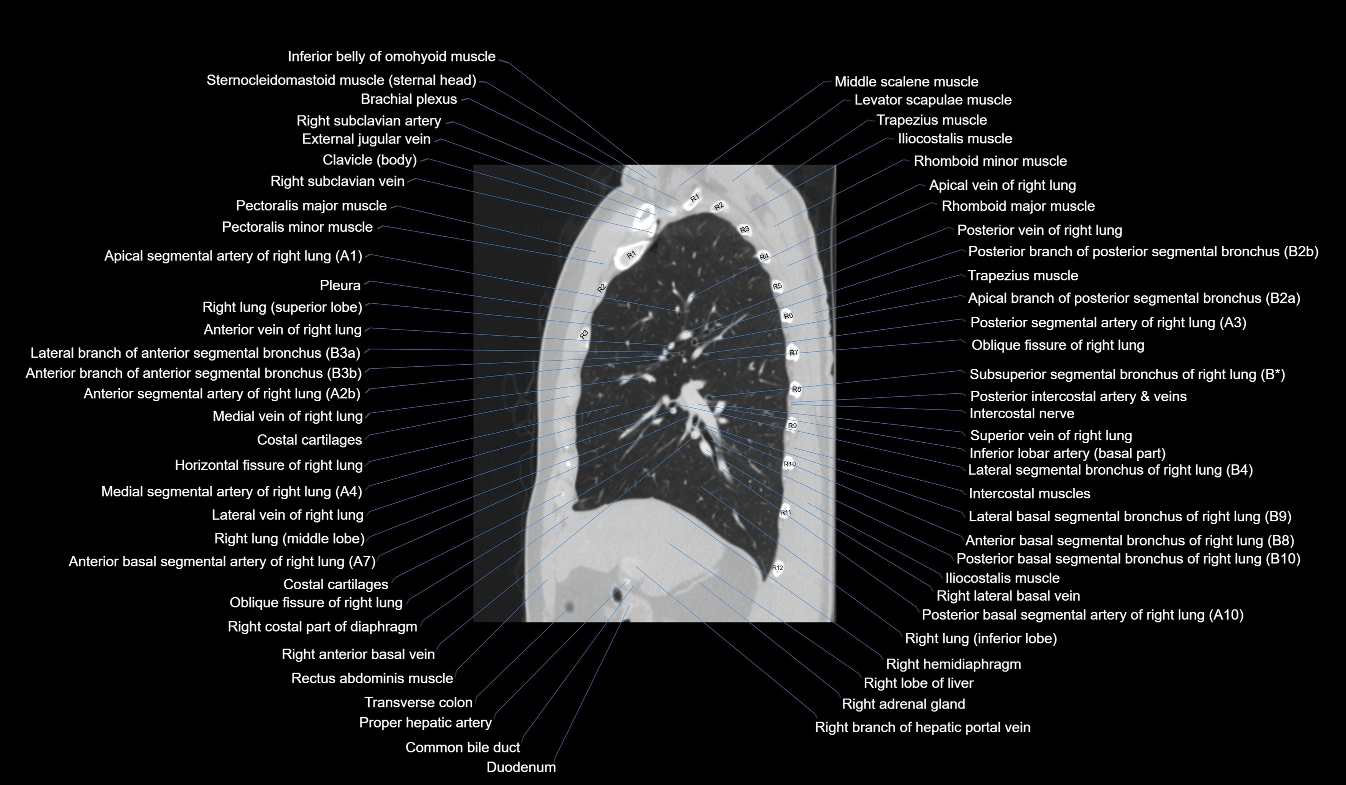 CT chest (thorax) labelled sagittal cross sectional anatomy radiology image-00054.webp